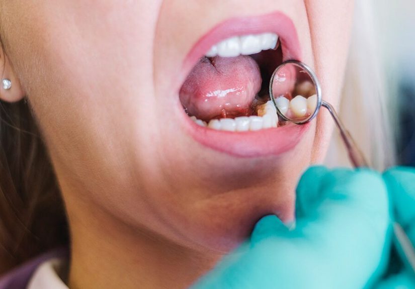 How Long Does Oral Cancer Take to Spread?