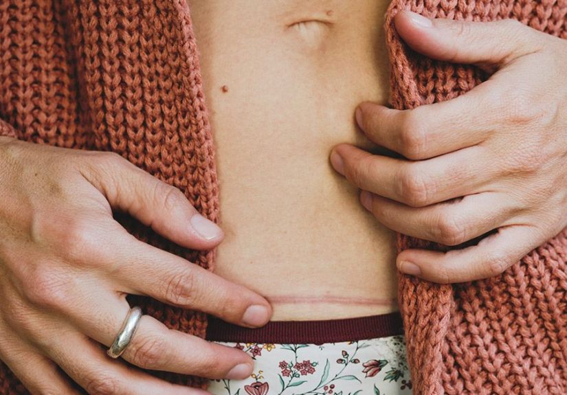 Incisional Hernia: Symptoms, Causes, Risk Factors, and Treatment