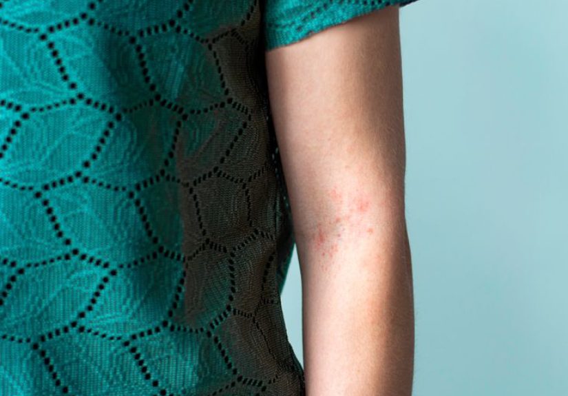 Mental Health Spotlight: Psoriasis in Men