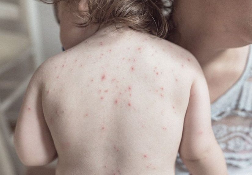 Puntos rojos en la piel: Imágenes, causas y cuándo buscar ayuda