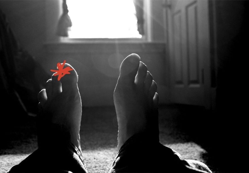 Septic arthritis pictures, symptoms, and treatment options