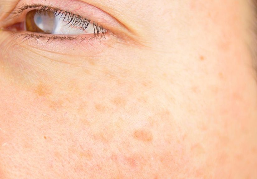 Sunspots on Face: Causes, Treatments, Prevention and Skin Cancer