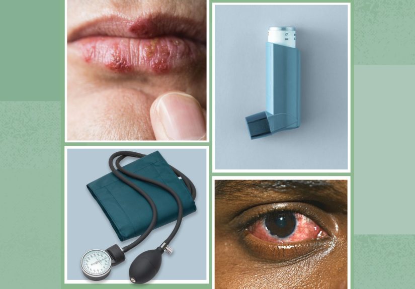 6 Long-Term Complications of Atopic Dermatitis