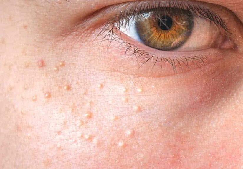 7 Ways to Get Rid of Milia and When to See a Professional