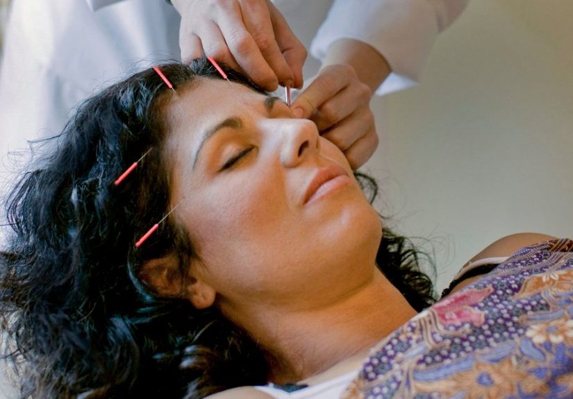 Acupuncture for Hair Loss: Is it Effective?