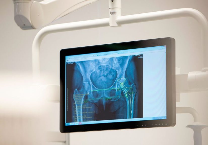 Avascular Necrosis in Sickle Cell Disease: Symptoms, Treatment