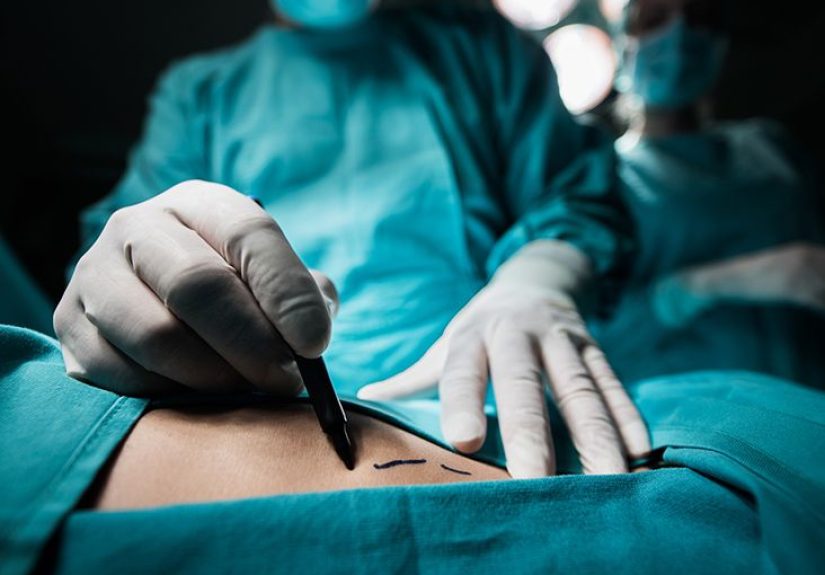 CoolSculpting vs. Liposuction: Cost, Side Effects, Pictures, More