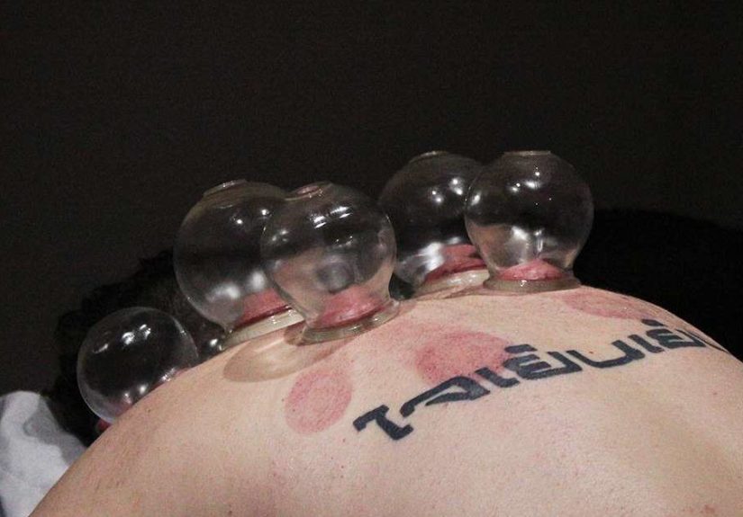 Cupping: Is it as Painful as it Looks?