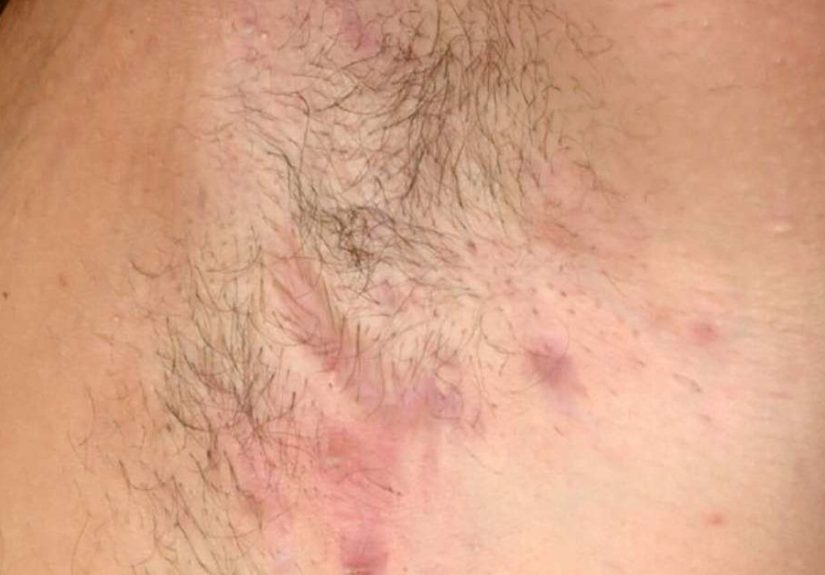 Hidradenitis suppurativa: Pictures, treatment, and symptoms
