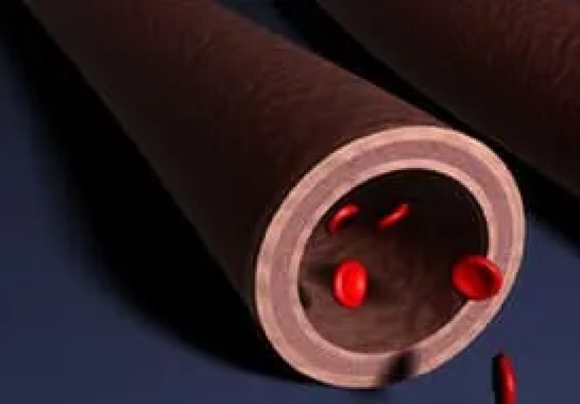 High Blood Pressure Damage to Arteries - Watch WebMD Video