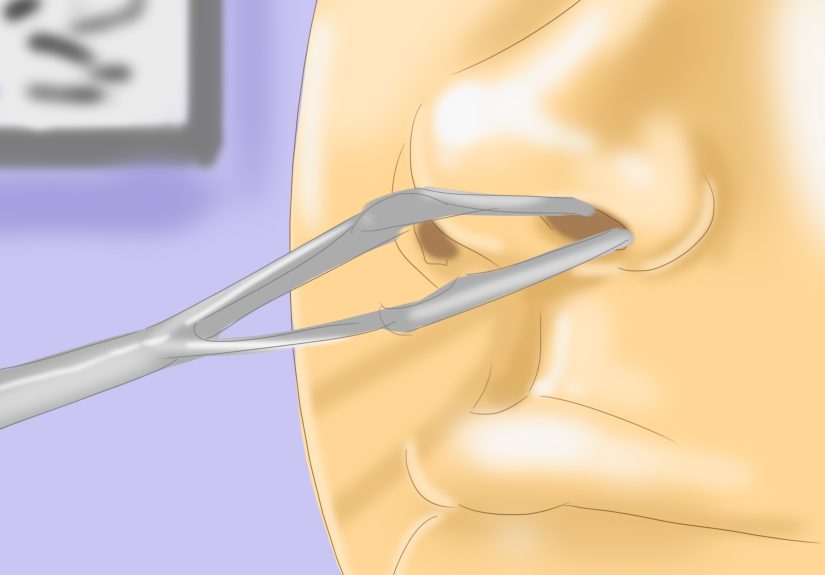 How to Keep the Nose Moist to Prevent Nosebleeds: Nasal Care