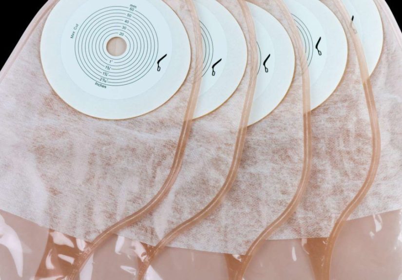 Ileostomy: Preparation, recovery, and what to expect