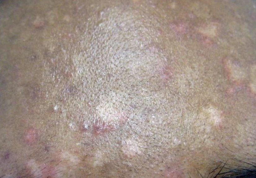 Manchas blancas en la piel: Posibles causas y tratamientos