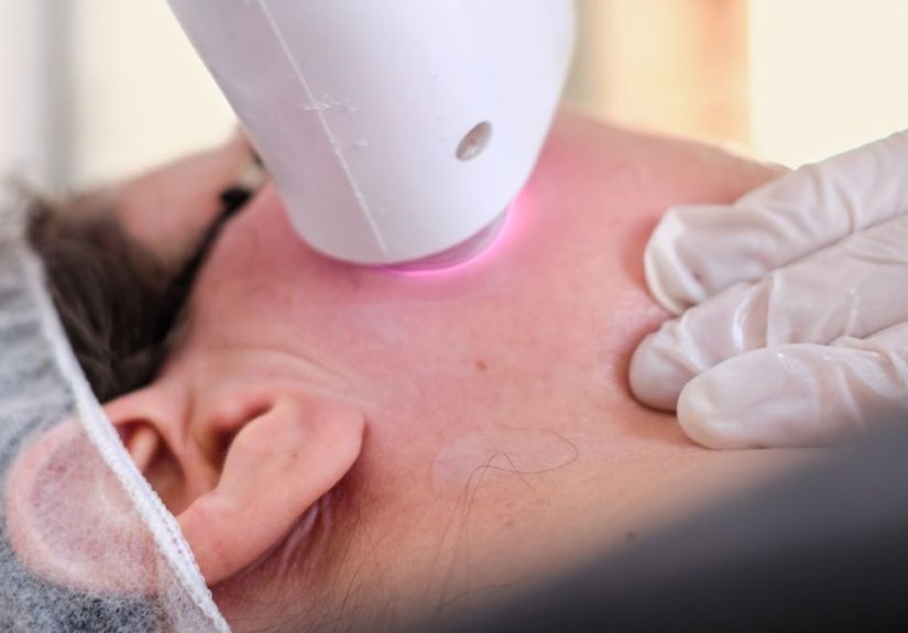 Melasma Laser Treatments: Effectiveness, Types of Lasers, and More