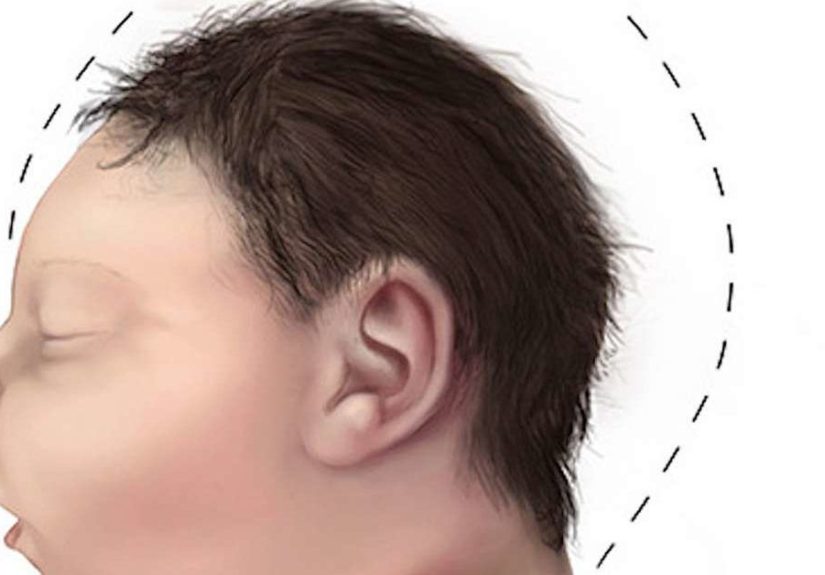 Microcephaly: Causes, Symptoms, and Treatment