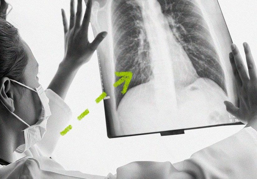 Paraseptal emphysema: Symptoms, outlook, and more