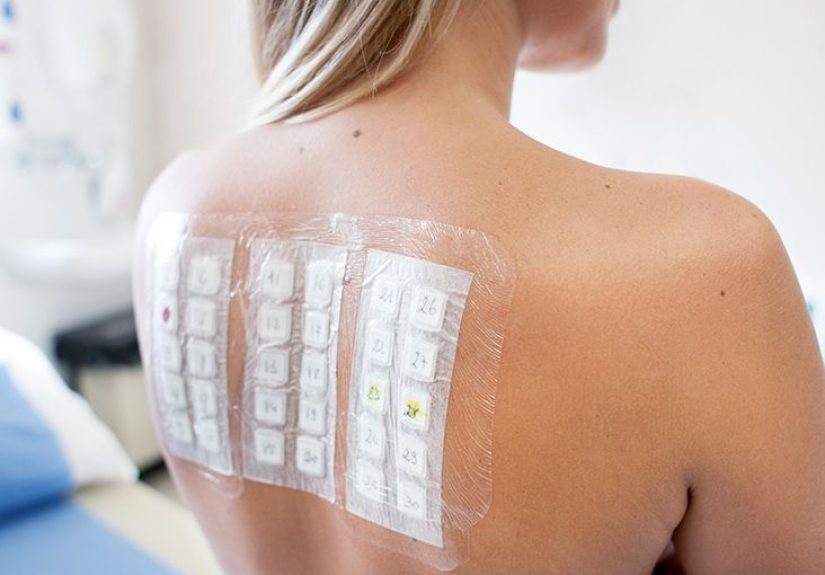 Pruebas de alergia para la colitis ulcerosa: Lo que debes saber