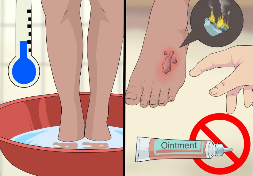 3 Ways to Treat a Serious Burn