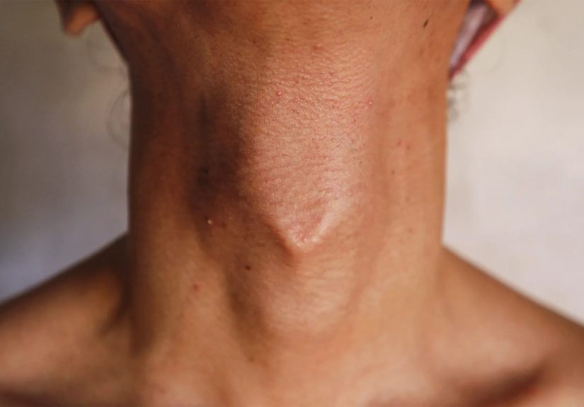 Adam's Apple: How it Develops & Surgical Options