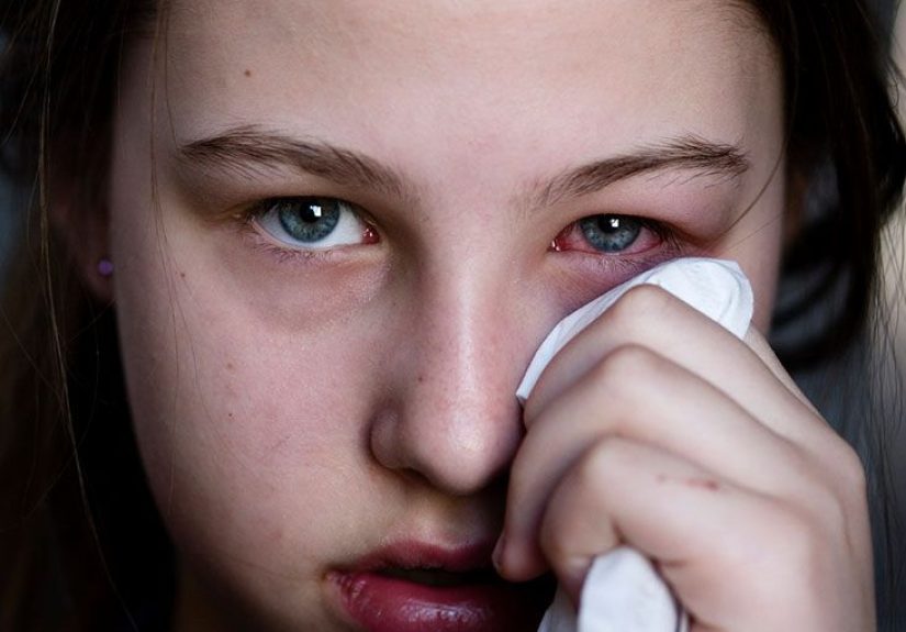 How Long Does Pink Eye Last? Viral vs. Bacterial Pink Eye