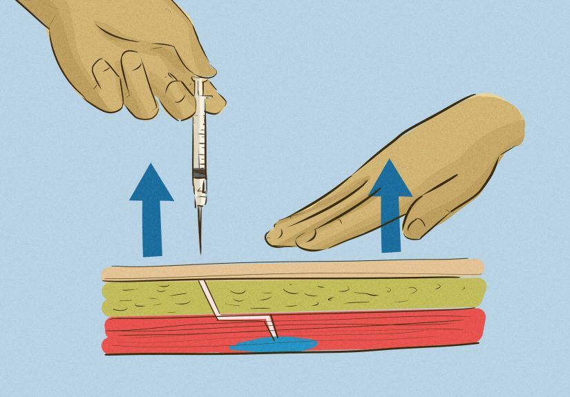 How to Give an Intramuscular Injection