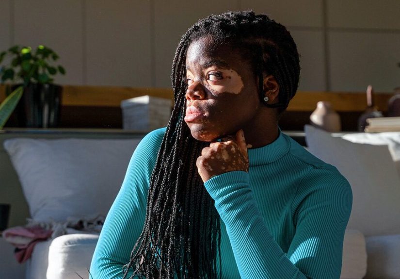 How Vitiligo Progresses: Your FAQs