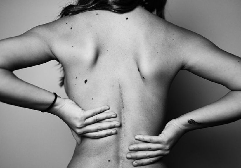 Is practicing good posture beneficial for scoliosis?