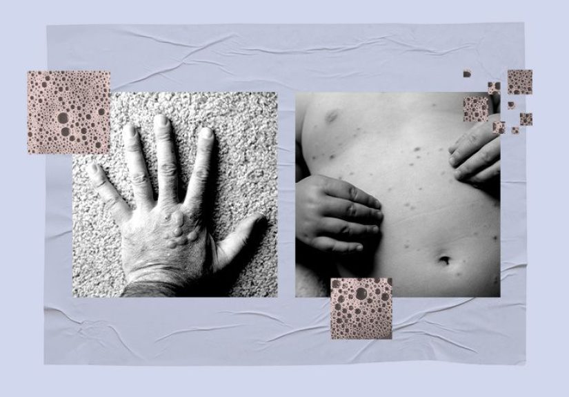 Itchy bumps filled with clear liquid: Causes and treatment