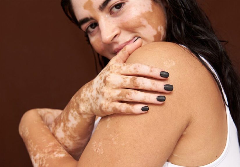 Life With Vitiligo: 8 Questions to Ask Your Doctor