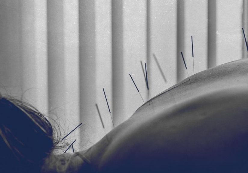 Multiple sclerosis and acupuncture: Benefits and risks