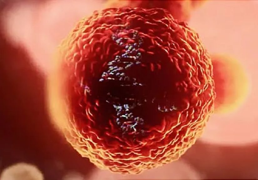 Myelofibrosis Video on Common Symptoms