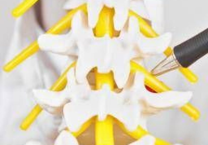 Neural foraminal stenosis: Definition, causes, and treatment