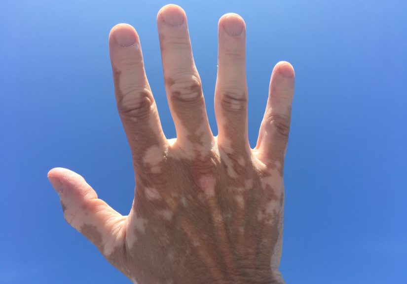 The Story of an Indian Doctor With Vitiligo