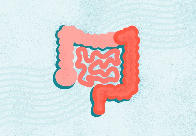 Ulcerative Colitis (UC): Symptoms, Causes, Diagnosis, and Treatment
