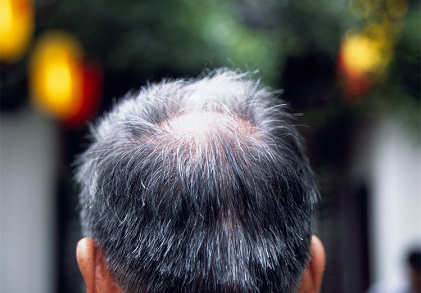 Why is my hair falling out? 10 causes of hair loss