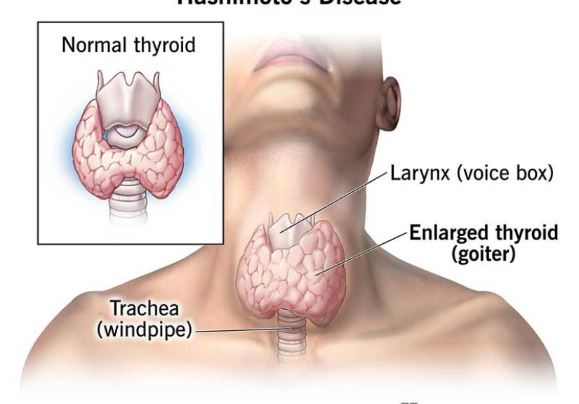 Hashimoto’s Disease: What It Is, Symptoms & Treatment