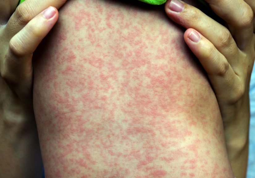 Measles outbreaks: Getting to the root of the problem