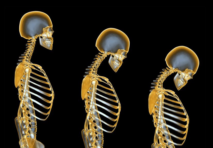 Osteoporosis: Causes, Risk Factors, Diagnosis, and Treatment
