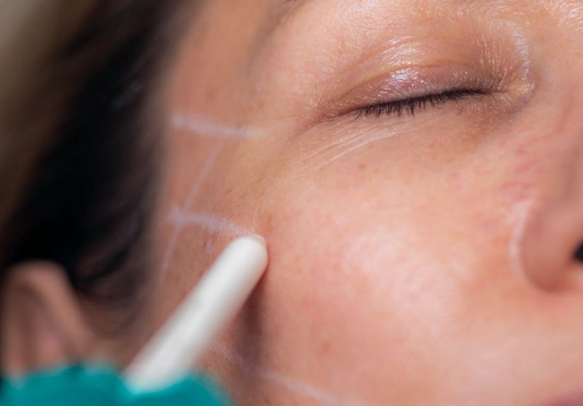What Is FaceTite? Procedure, Recovery, and More